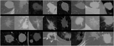 Accurate classification of lung nodules on CT images using the TransUnet